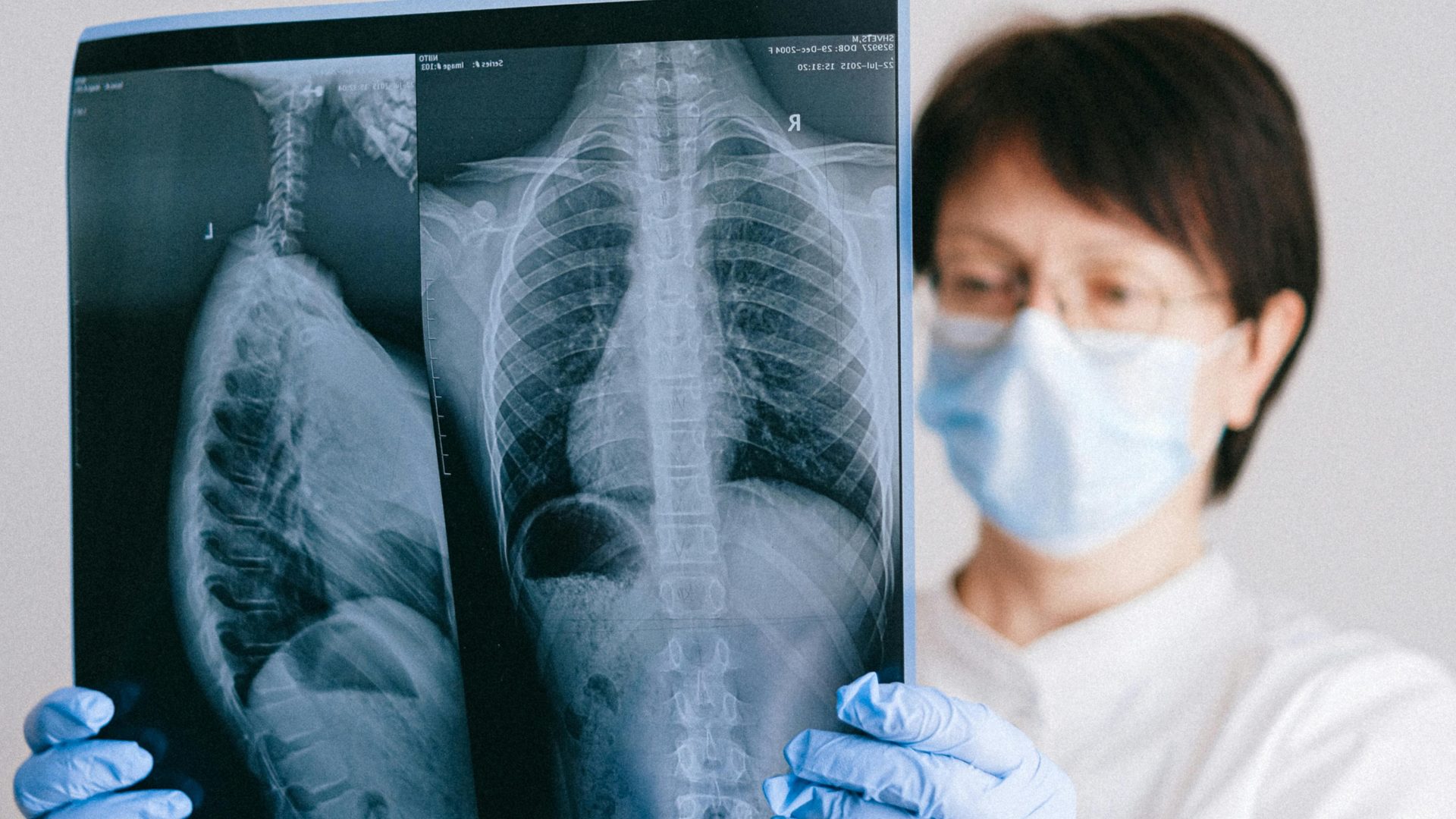 Artificial intelligence in the diagnosis of spinal fractures